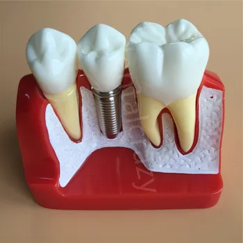 Zubné Učiť Implantát Analýza Koruny Most Vymeniteľné Model Zubné Demonštrácia Zuby Model