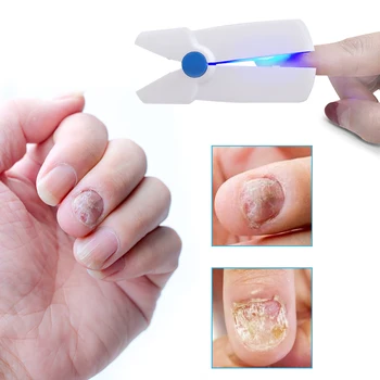 Liek Nechtov Laserové Ošetrenie pre Onychomycosis Ringworm Nechty Plesňové Infekcie Studený Laser Terapia Domáce Použitie