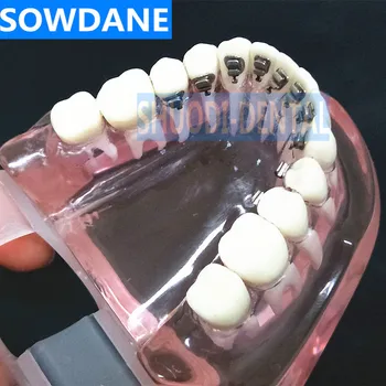 Zubné Ortodontická Model S Kultúrne Držiaky na Zubný lekár-Pacient Komunikácie Štúdia Transparentné Zub Model