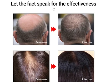Rýchly Rast Vlasov Pre Mužov, Ženy Podstate Silný Starostlivosť O Vlasy Esenciálny Olej Strata Vlasov Liečba Zázvor Ťažba