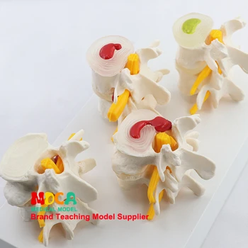 Ľudská kostra Odbor ortopédia výučby chrbtice model lézie bedrových model lekárske výučby MYZ005