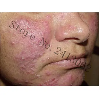 Rosacea Krém Akné Remover Cream Blackhead Odstraňovač Červený Nos Masť Bylinné Anti-akné a Roztoč Akné Krém na Ošetrenie Akné