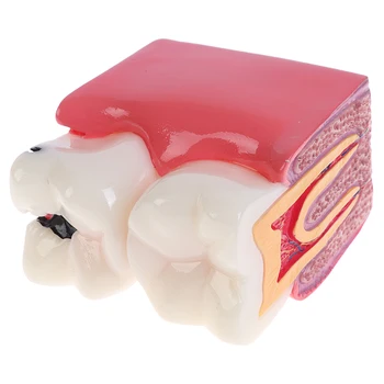Zubné Zuby Model 6-Krát Kazu Comparation Štúdia Zubnej Protézy Modely